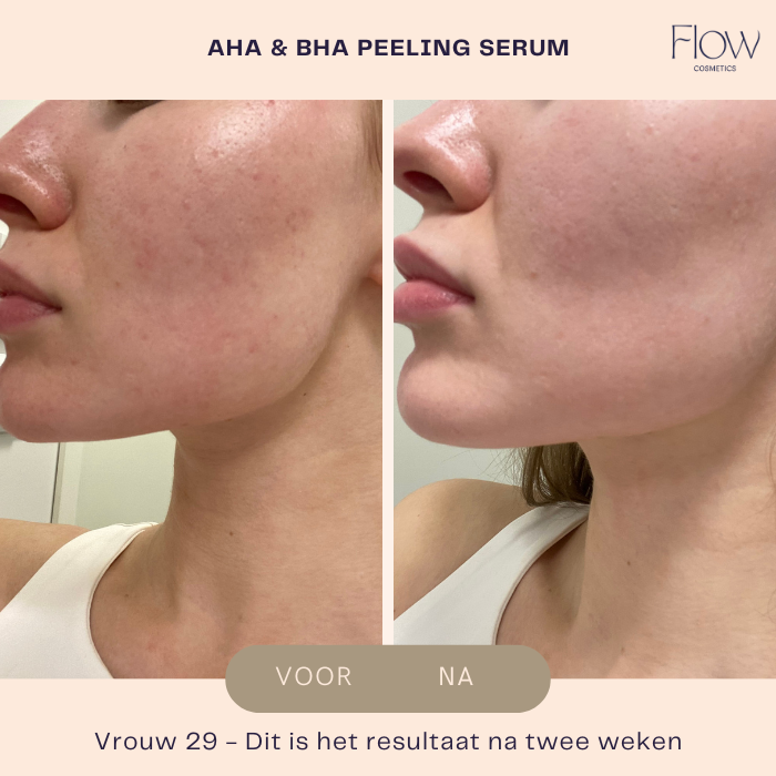 AHA &amp; BHA Peeling Serum - Facial Peeling - Flow Cosmetics - 30ml